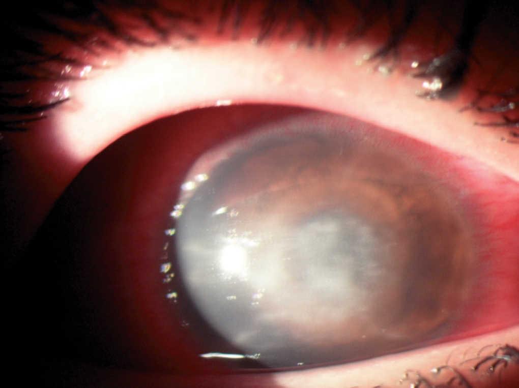 Queratitis En Portador De Lentes De Contacto Enfermedades Infecciosas Y Microbiologia Clinica