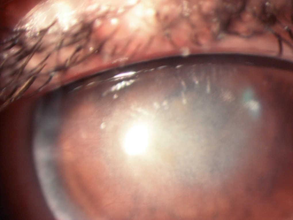 Queratitis En Portador De Lentes De Contacto Enfermedades Infecciosas Y Microbiologia Clinica