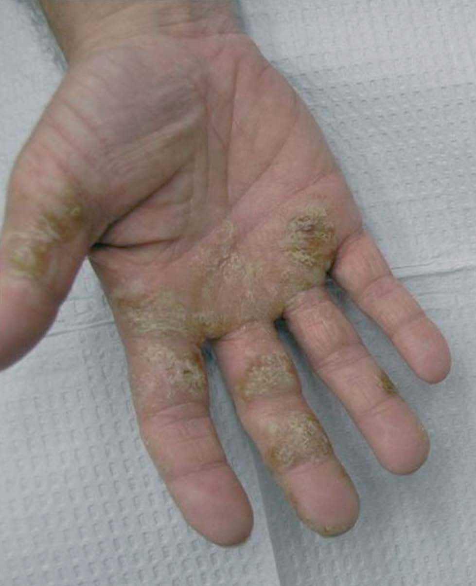 Dermatitis de manos Actas