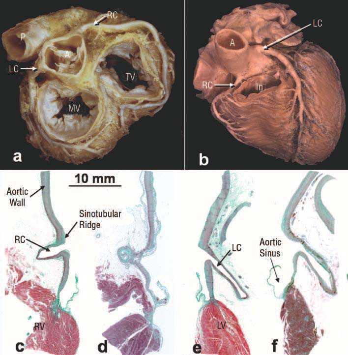 Structural Features Of The Sinus Of Valsalva And The Proximal Portion Of The Coronary Arteries Their Relevance To Retrograde Aortocoronary Dissection Revista Espanola De Cardiologia