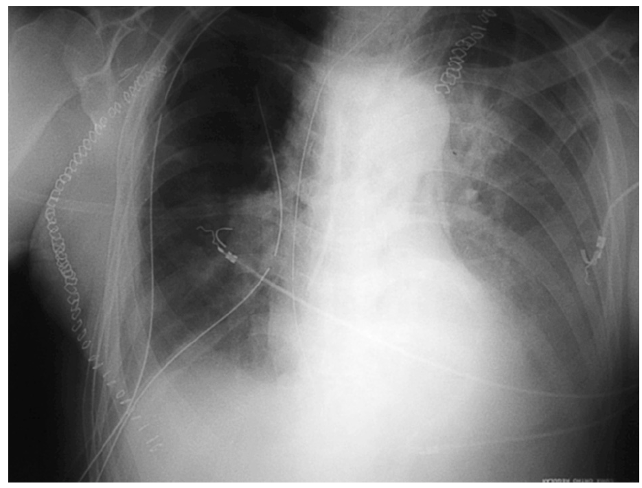 radiografía de cáncer de esófago