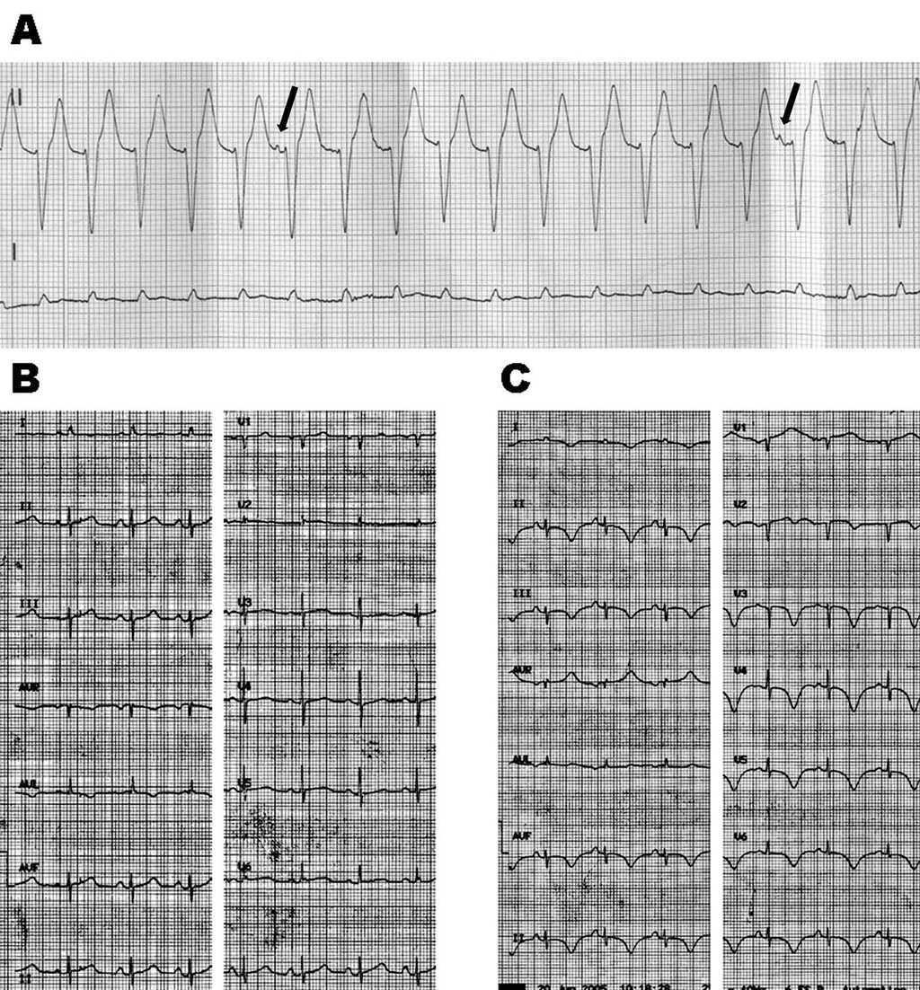 Aborted Sudden Death Secondary To Recurrent Transient Apical Dyskinesia Revista Espanola De Cardiologia