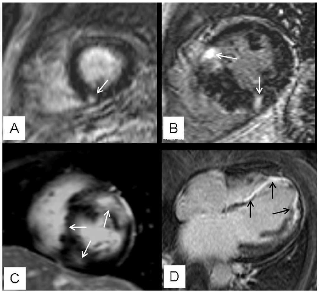 Detection And Quantification Of Myocardial Fibrosis In Hypertrophic Cardiomyopathy By Contrast Enhanced Cardiovascular Magnetic Resonance Revista Espanola De Cardiologia
