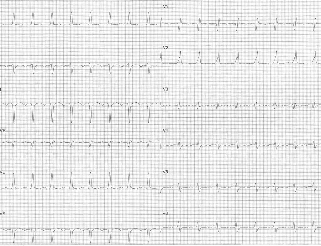 Kearns-Sayre Syndrome: Recurrent Syncope and Atrial Flutter | Revista ...