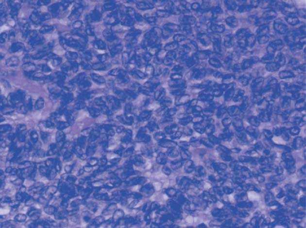 Tumor de células da granulosa do ovário - Sanar Medicina