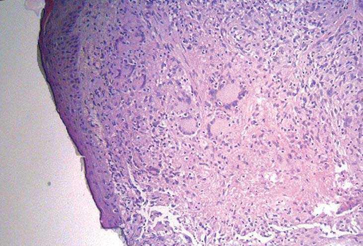 Lesión Ulcerada De Evolución Rápida En Mujer Joven Enfermedades