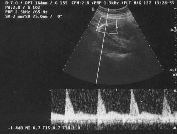 Neurofibromatosis Y Embarazo Con Resultado De Muerte Fetal Caso Clinico Progresos De Obstetricia Y Ginecologia