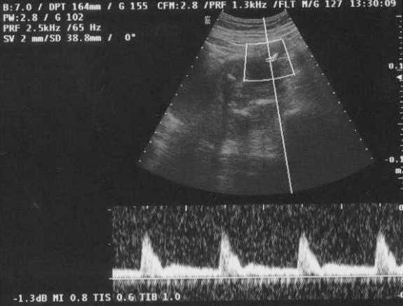 Neurofibromatosis Y Embarazo Con Resultado De Muerte Fetal Caso Clinico Progresos De Obstetricia Y Ginecologia