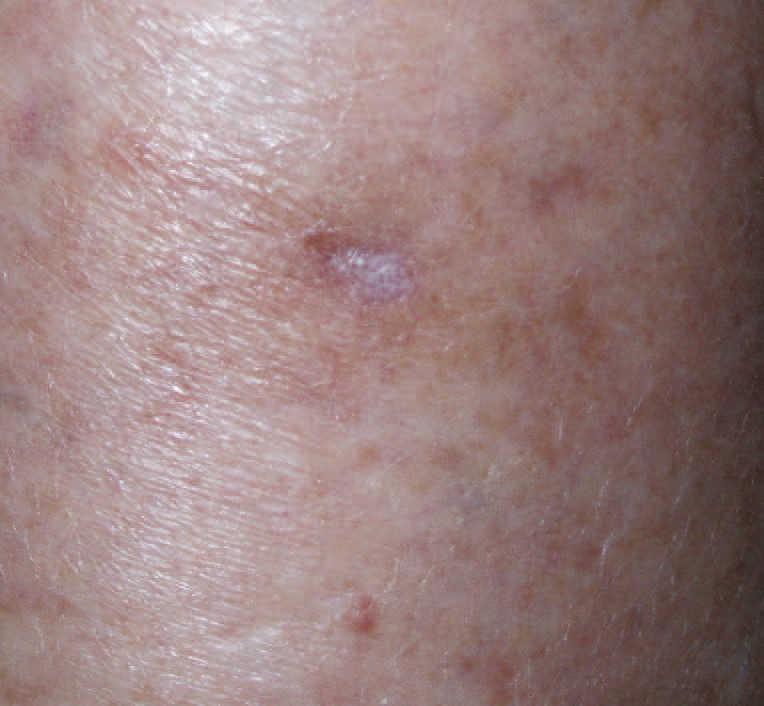 Terapia fotodinámica: nuevas indicaciones | Actas Dermo-Sifiliográficas