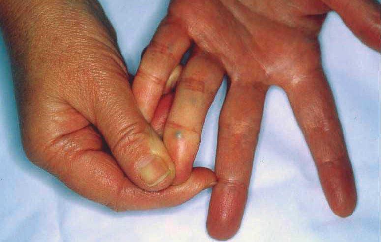 Permanente Arqueólogo sol Nódulo azulado en mano | Actas Dermo-Sifiliográficas