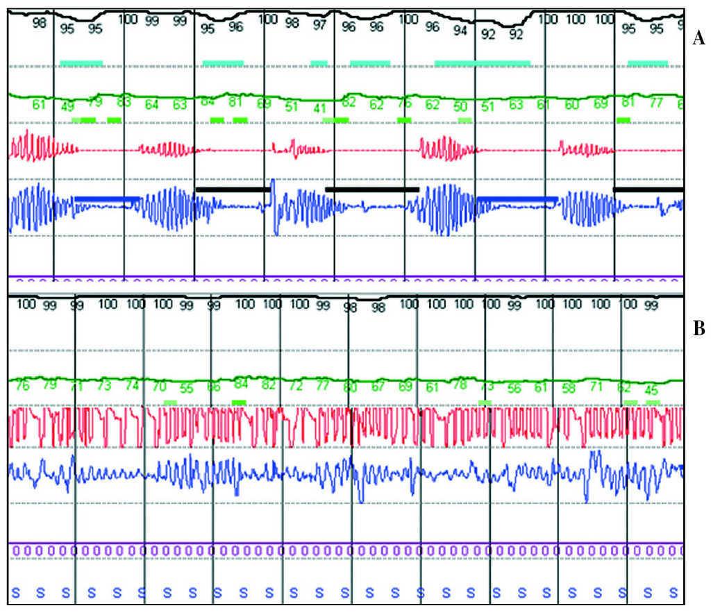 Síndrome de apnea central de origen multifactorial tratado mediante