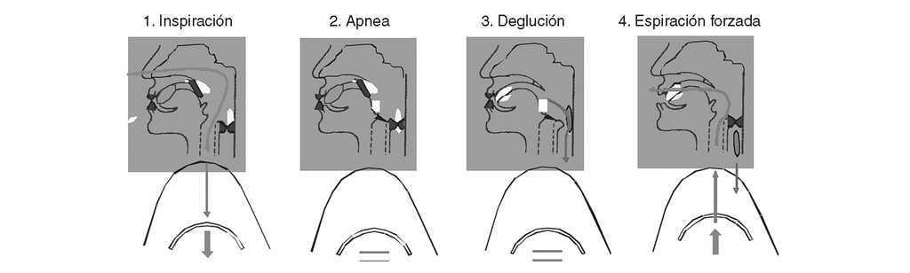 Diagnostico Y Tratamiento De La Disfagia Orofaringea Funcional Aspectos De Interes Para El Cirujano Digestivo Cirugia Espanola