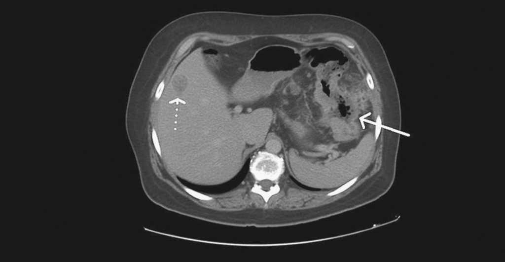 Tumor Mixto Del Colon Con Metastasis Hepaticas Cirugia Espanola