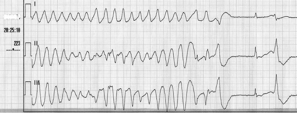 Recomendaciones Para El Tratamiento De La Torsade De Pointes A Proposito De Un Caso Medicina De Familia Semergen