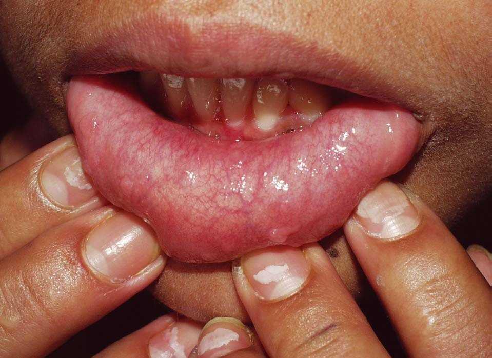 Virus del papiloma humano verrugas en la boca, - Verrugas de papiloma en la boca