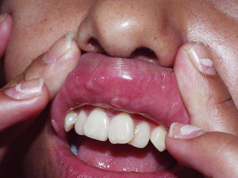 Papiloma labios boca Papiloma en los labios de la boca. Gardasil hpv kullananlar