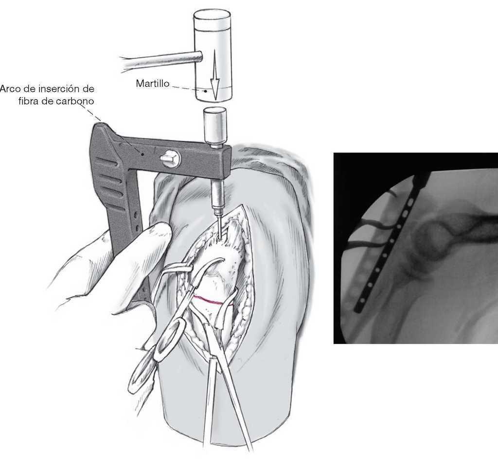 carga Joseph Banks Susteen Clavo intramedular encerrojado a compresión para el tratamiento de las  fracturas de olécranon | Técnicas Quirúrgicas en Ortopedia y Traumatología