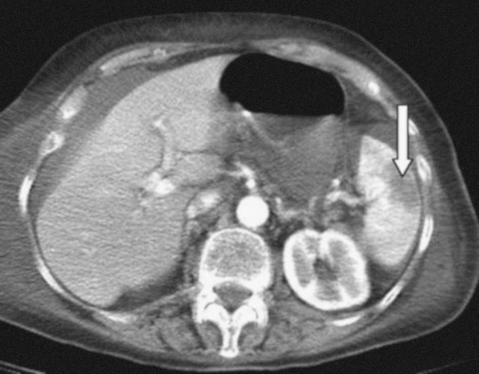 Radiografía de tórax en un paciente con enfermedad de Niemann Pick