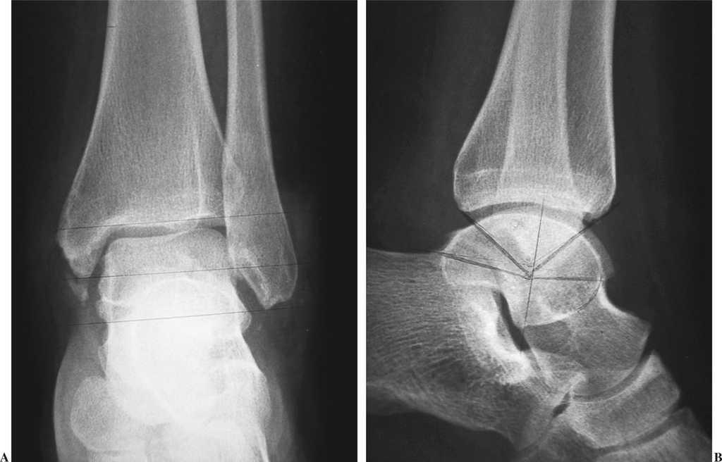 Luxaciones de tobillo sin fractura cuatro casos Revista Española de Cirugía Ortopédica y