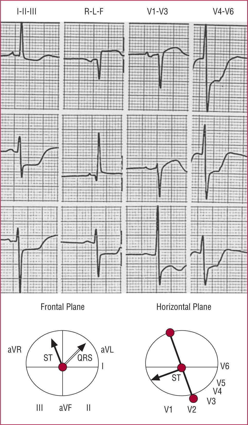 Electrocardiographic Diagnosis Of Left Main Coronary Artery Obstruction Using St Segment And Qrs Complex Vector Analysis Revista Espanola De Cardiologia