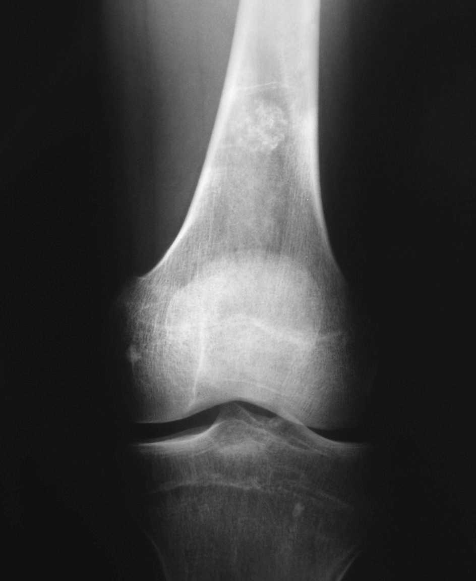 simptome de osteocondroză la șold articulațiile piciorului rănesc picioarele