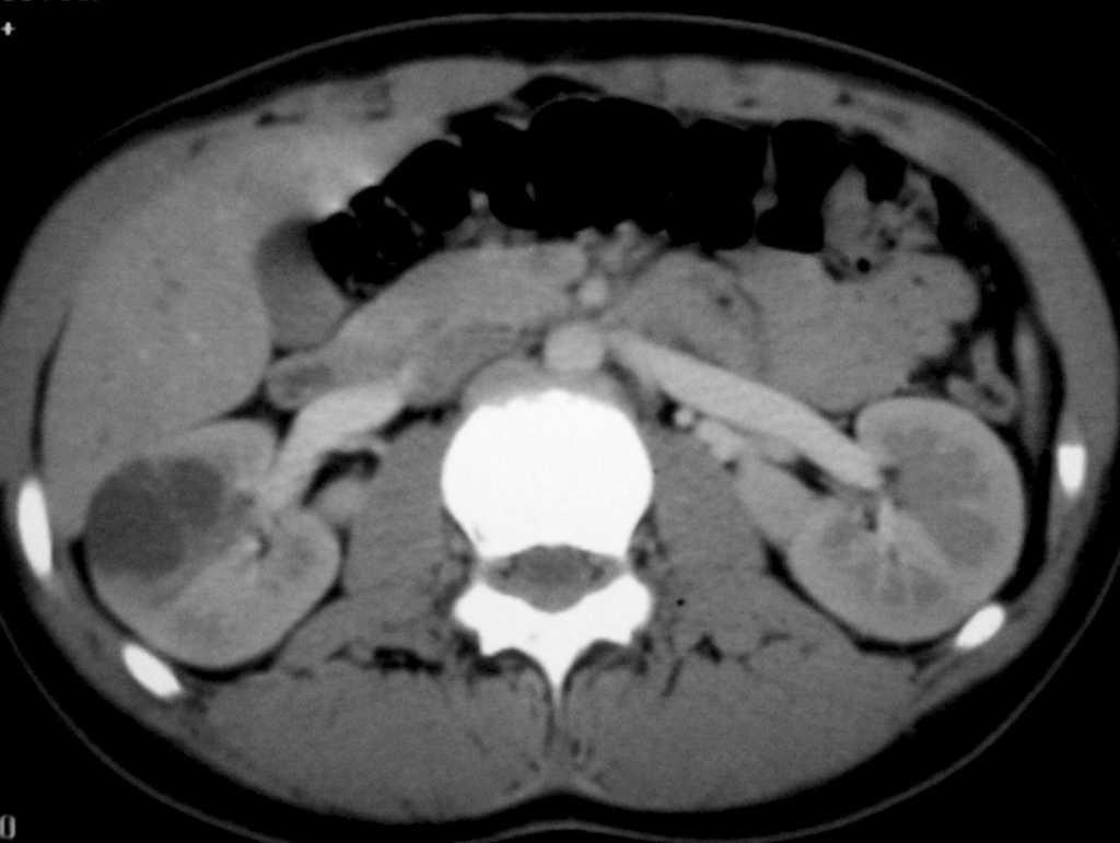 Hallazgos Radiológicos De Los Tumores Renales No Wilms En La Edad