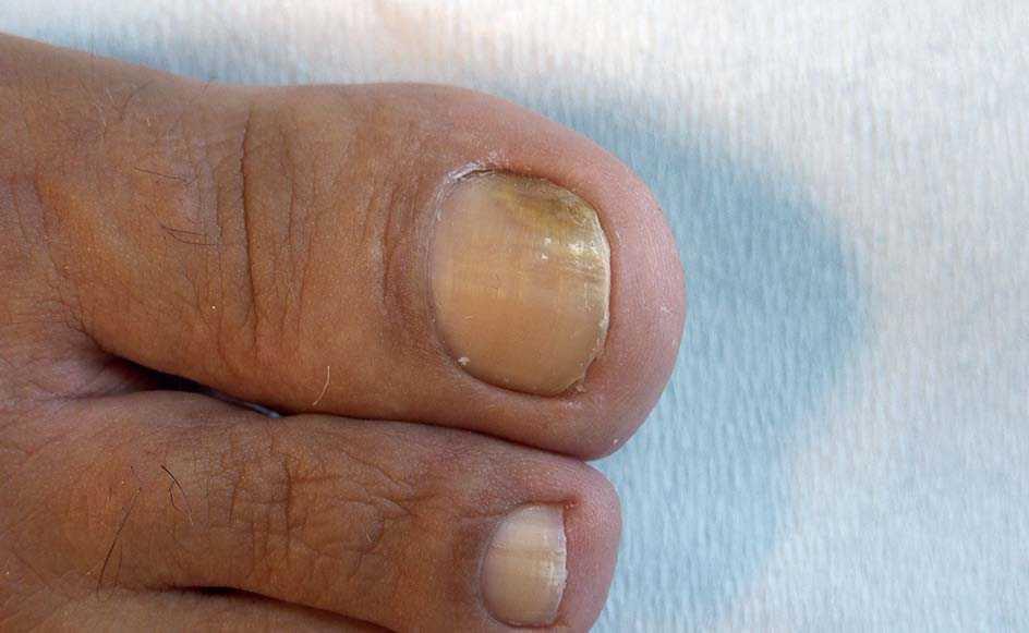 también estoy feliz Conquista Estrategias terapéuticas en las onicomicosis | Piel. Formación continuada en dermatología también estoy feliz Conquista Estrategias terapéuticas en las onicomicosis | Piel. Formación continuada en dermatología