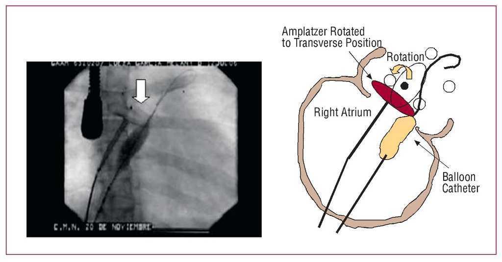 Correction of the Perpendicular Positioning of the Amplatzer Device