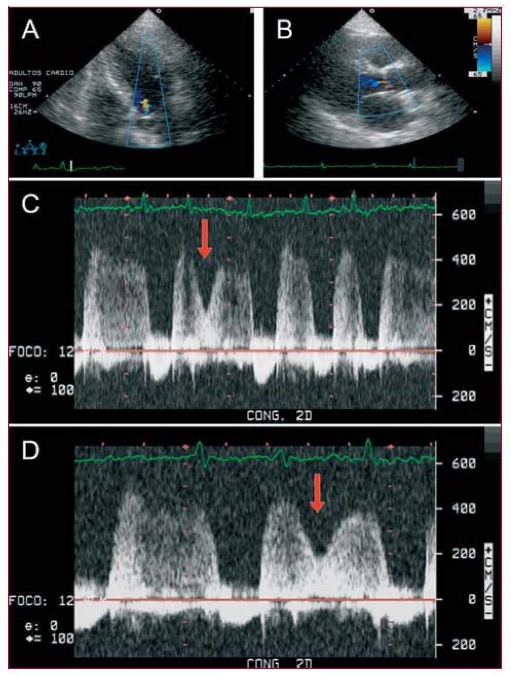 The Frequency Of Systolic Aortic Regurgitation And Its - 