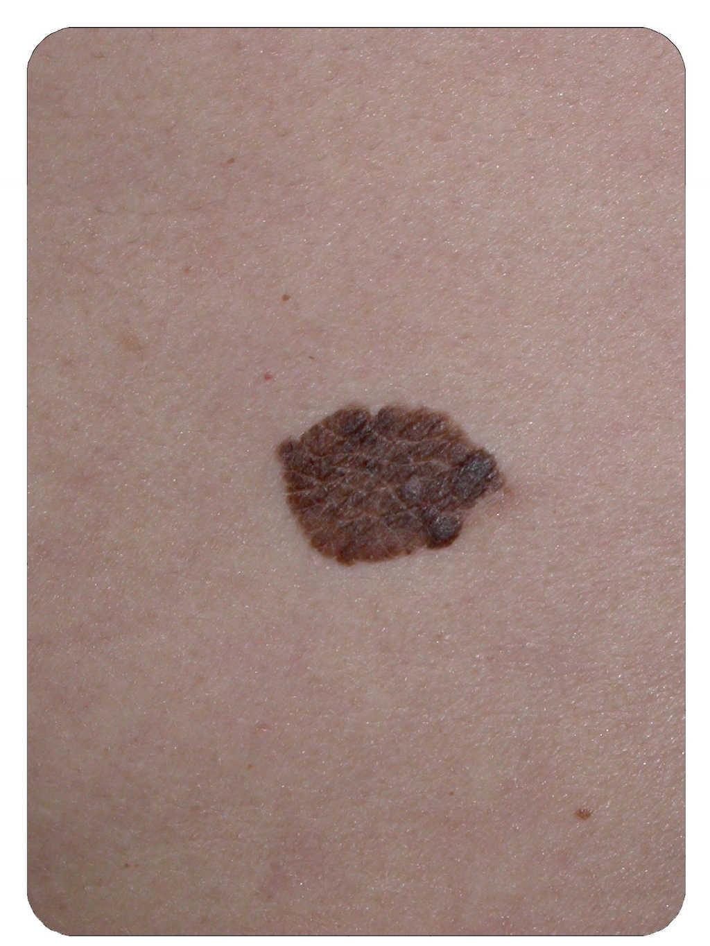 Papiloma en la piel tratamiento - nucleus-mc.ro, Que son papilomas en la piel