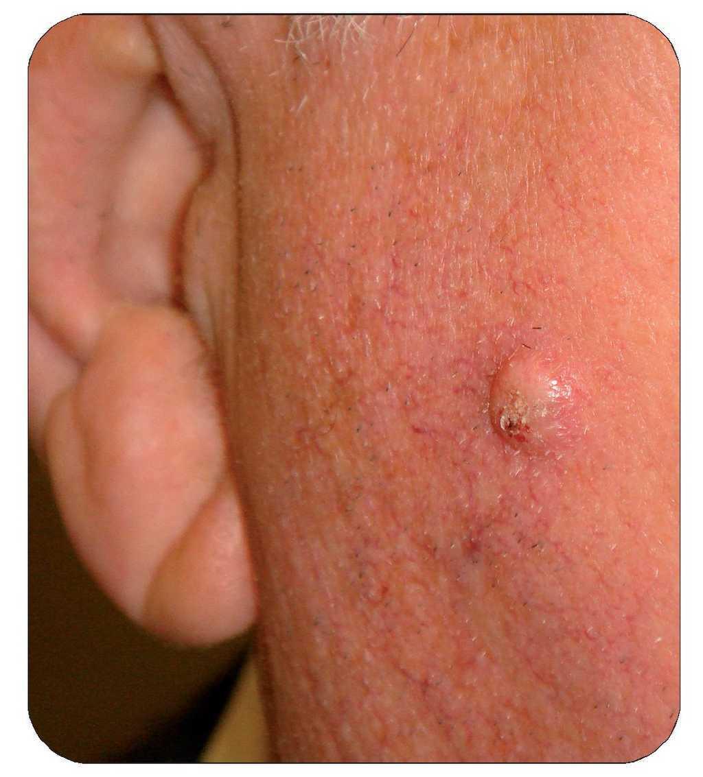 virus del papiloma lesiones helminths tratament cu bandă