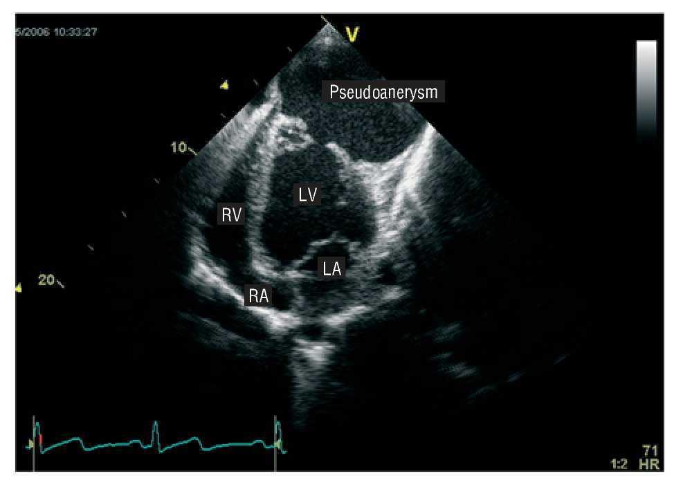 A Giant Left Ventricular Pseudoaneurysm in Behçet¿s Disease | Revista Española de Cardiología ...