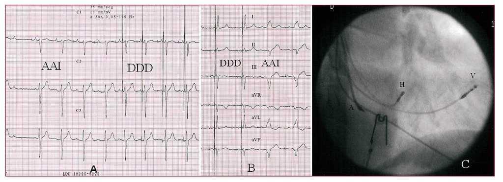 Posibilidades Y Realidades De La Estimulacion Permanente Del Haz De His Revista Espanola De Cardiologia