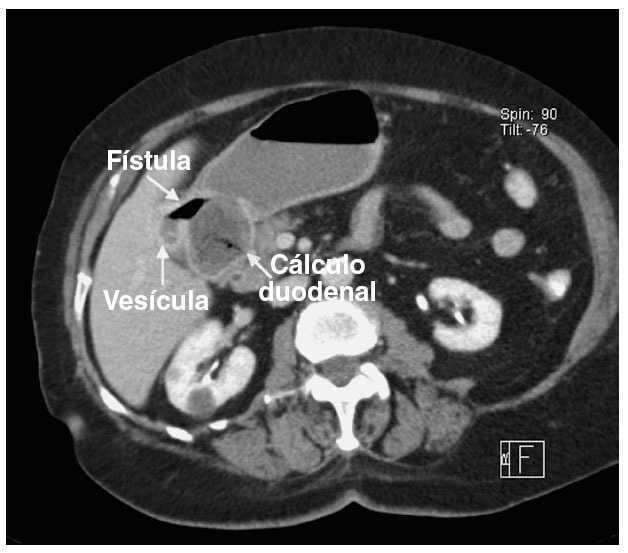 Síndrome de Bouveret Cirugía Española