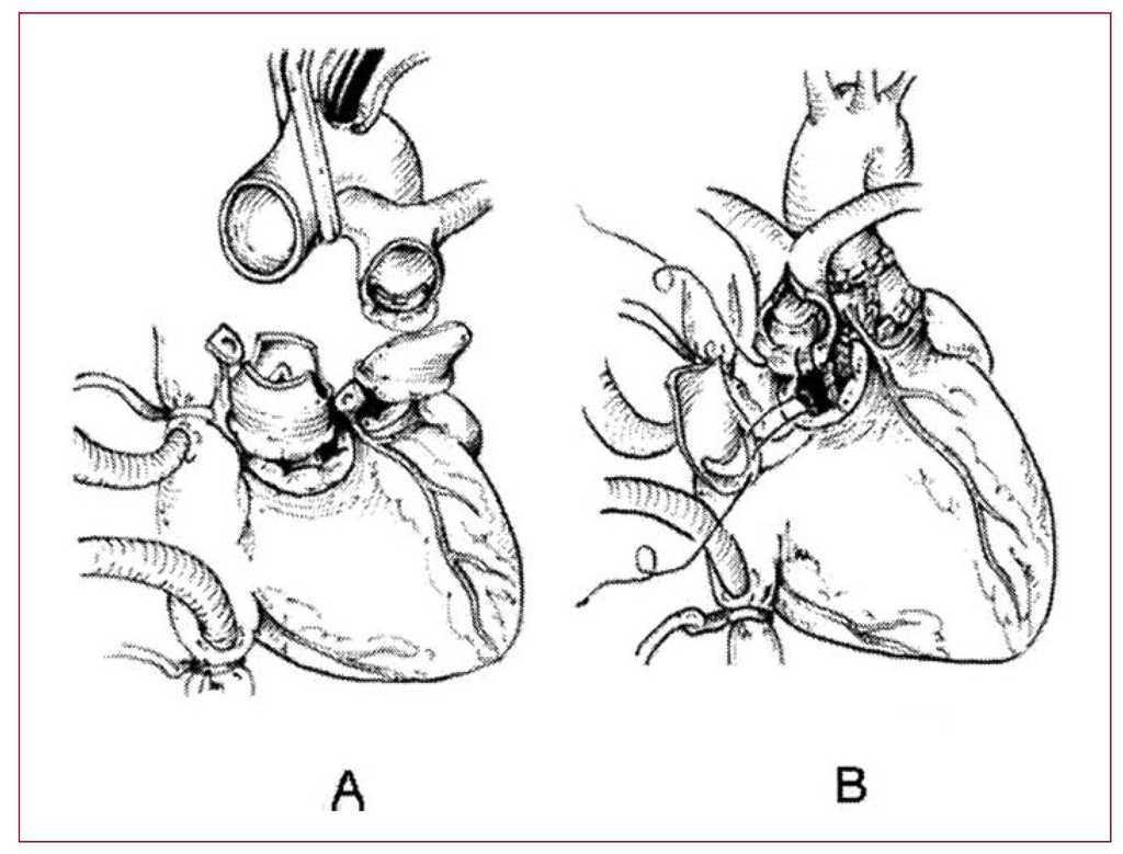 Nikaidoh Procedure for the Correction of Transposition of the Great  Arteries, Ventricular Septal Defect and Pulmonary Stenosis | Revista  Española de Cardiología