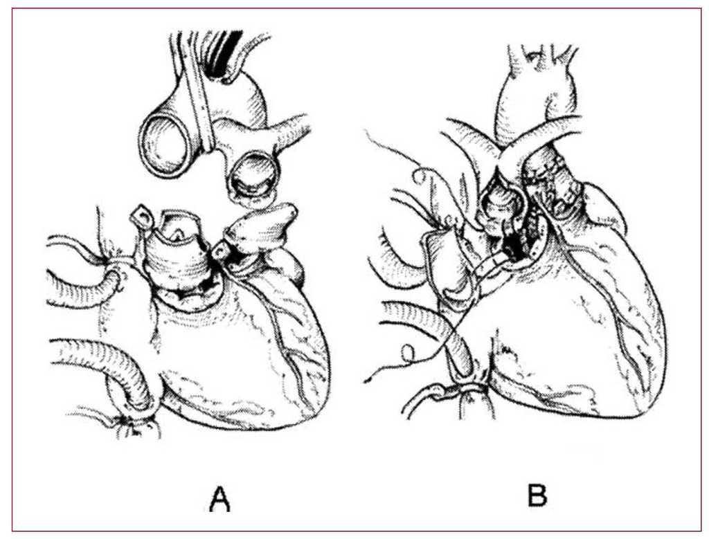Nikaidoh Procedure for the Correction of Transposition of the Great Arteries, Ventricular Septal Defect and Pulmonary Stenosis | Revista Española de Cardiología Nikaidoh Procedure for the Correction of Transposition of the Great Arteries, Ventricular Septal Defect and Pulmonary Stenosis | Revista Española de Cardiología