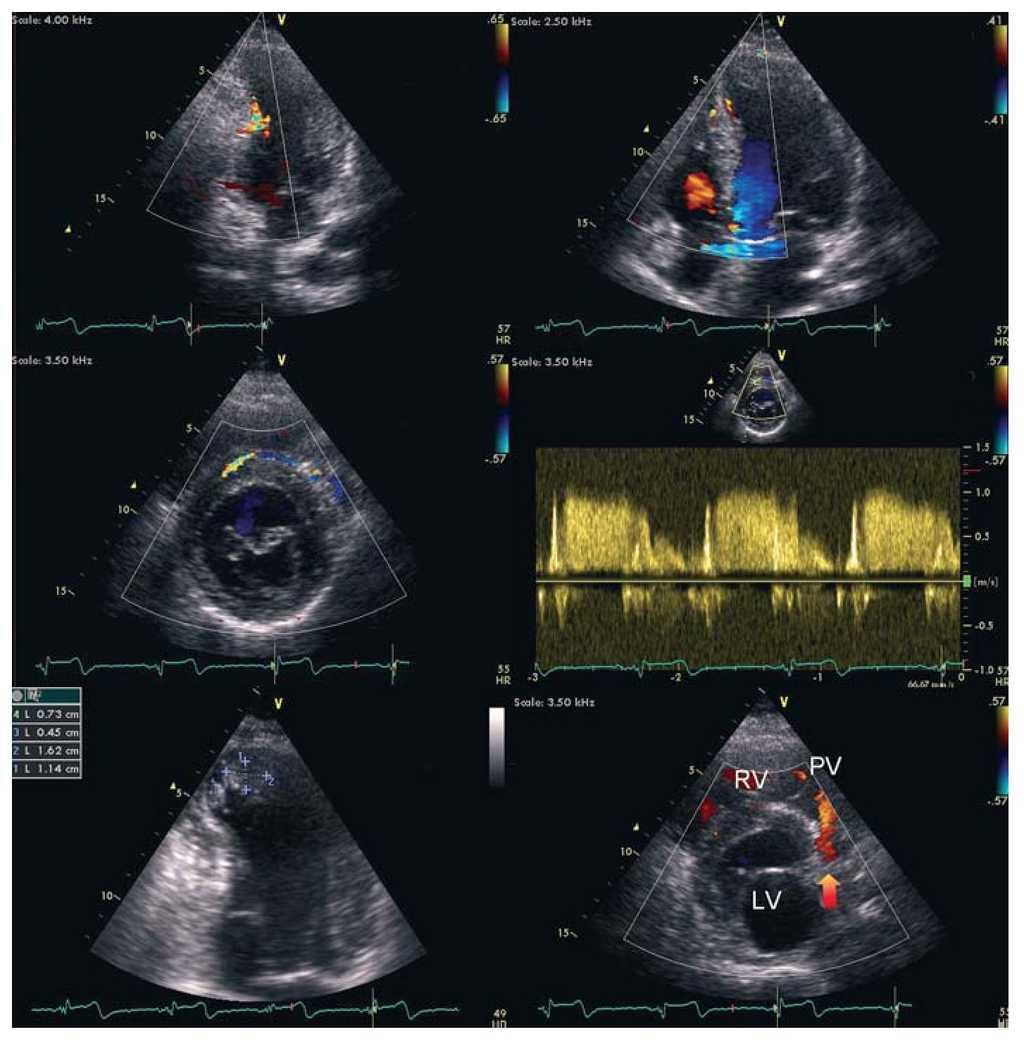 Anomalous Origin of the Left Coronary Artery: the Rare Coincidence of ...