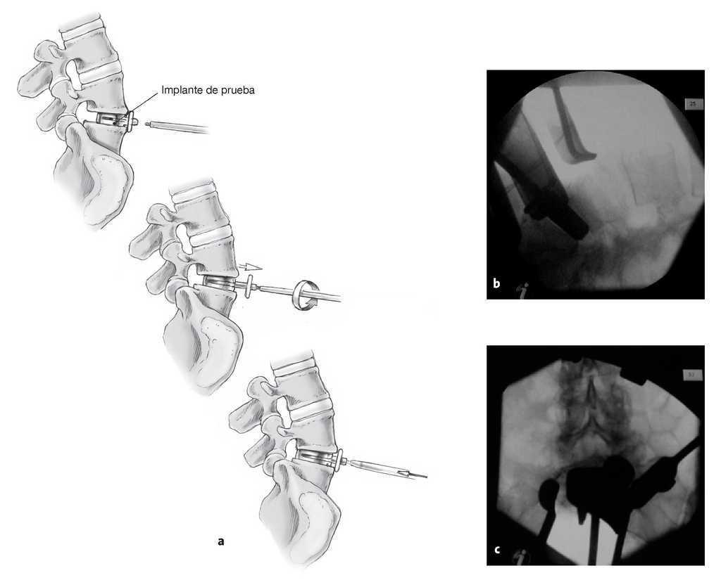 Colocación de una prótesis de disco intervertebral lumbar Prodisk