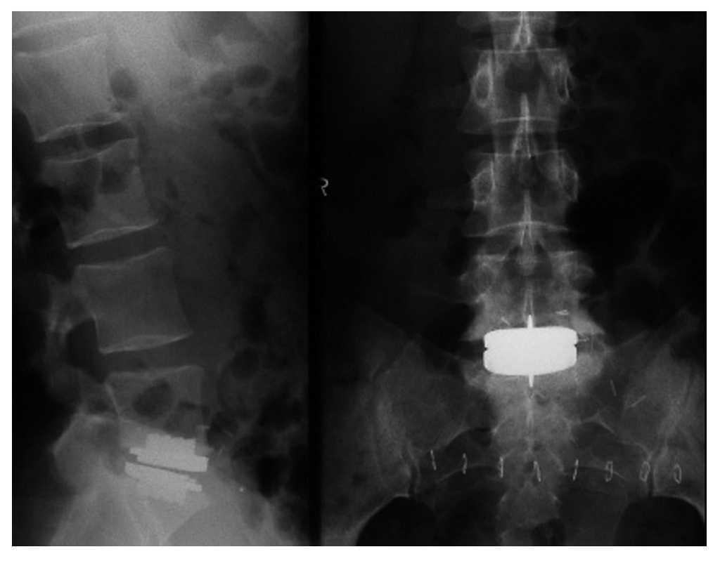 Colocación de una prótesis de disco intervertebral lumbar Prodisk