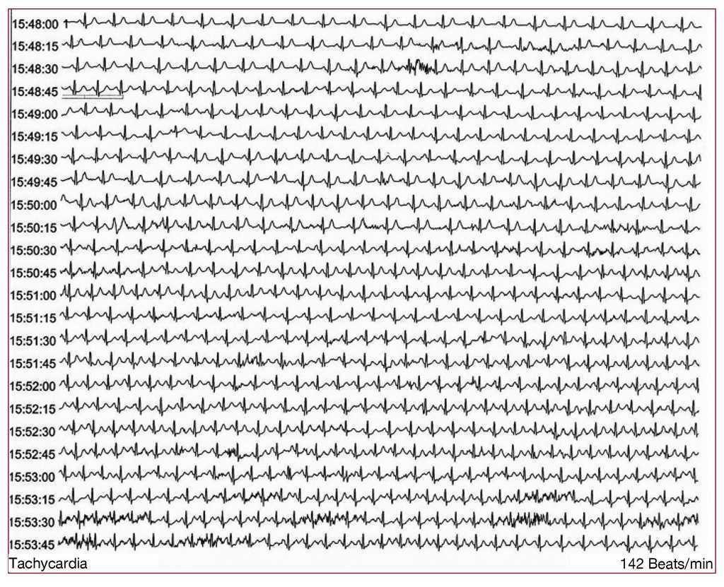 Ivabradine As A Treatment Option For Inappropriate Sinus Tachycardia Revista Espanola De Cardiologia Ivabradine As A Treatment Option For Inappropriate Sinus Tachycardia Revista Espanola De Cardiologia