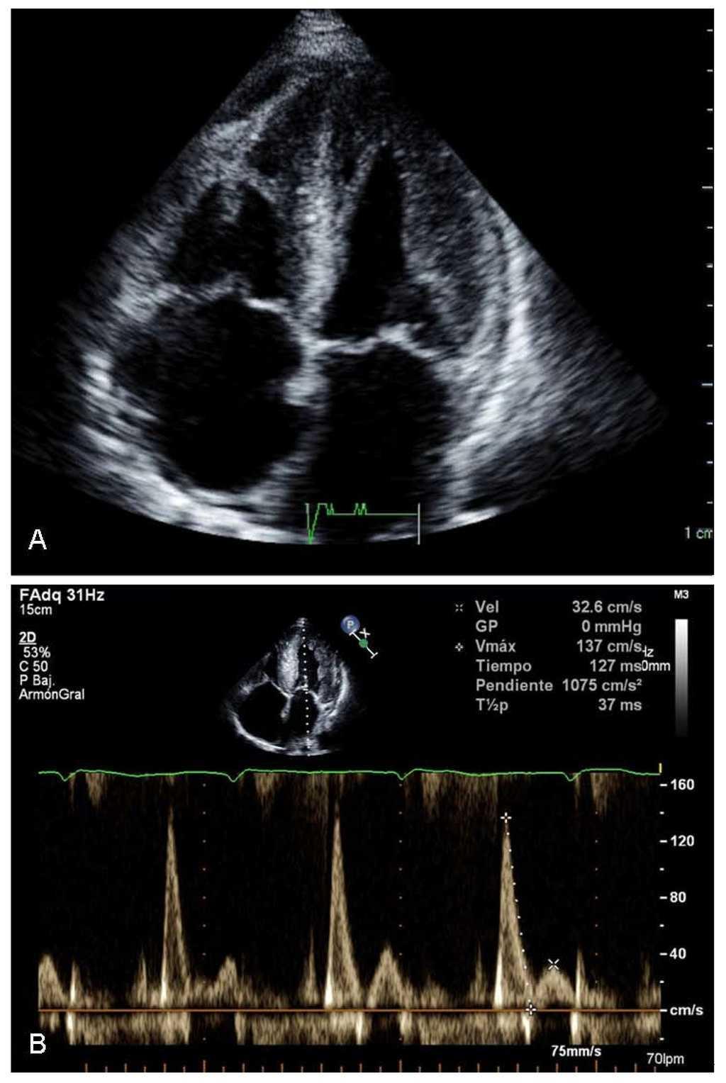 Cardiac amyloidosis: the value of myocardial strain echocardiography in  diagnosis and treatment - Stoodley - 2015 - Sonography - Wiley Online  Library