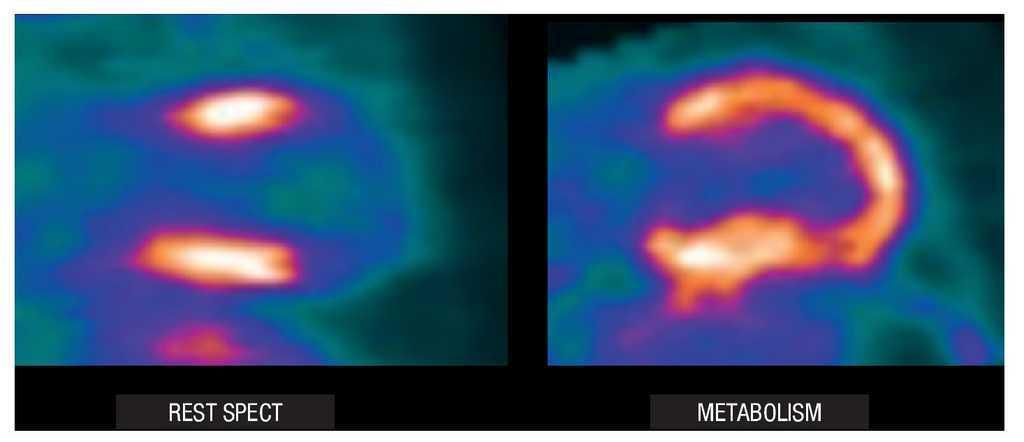 Assessment of Myocardial Viability Using Nuclear Medicine Imaging in  Dextrocardia