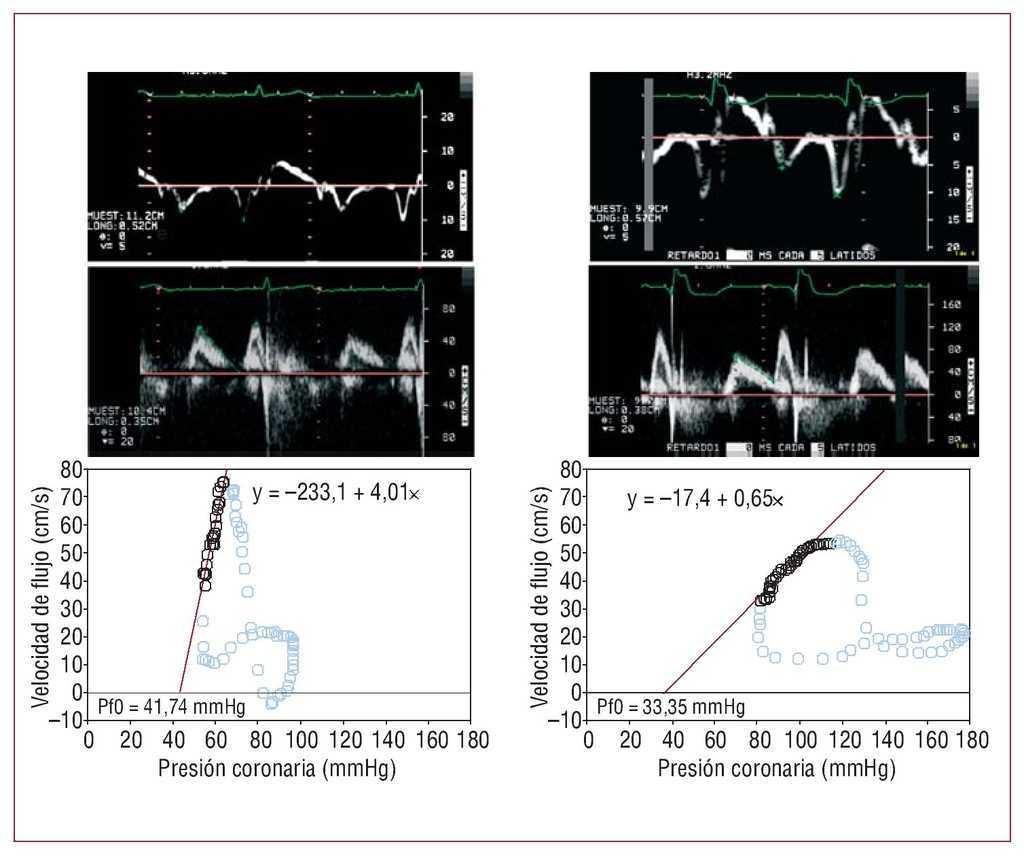 Disfuncion Diastolica Del Paciente Diabetico Estimada Con Ecocardiografia Doppler Relacion Con La Ateromatosis Y La Disfuncion Microcirculatoria Coronarias Revista Espanola De Cardiologia