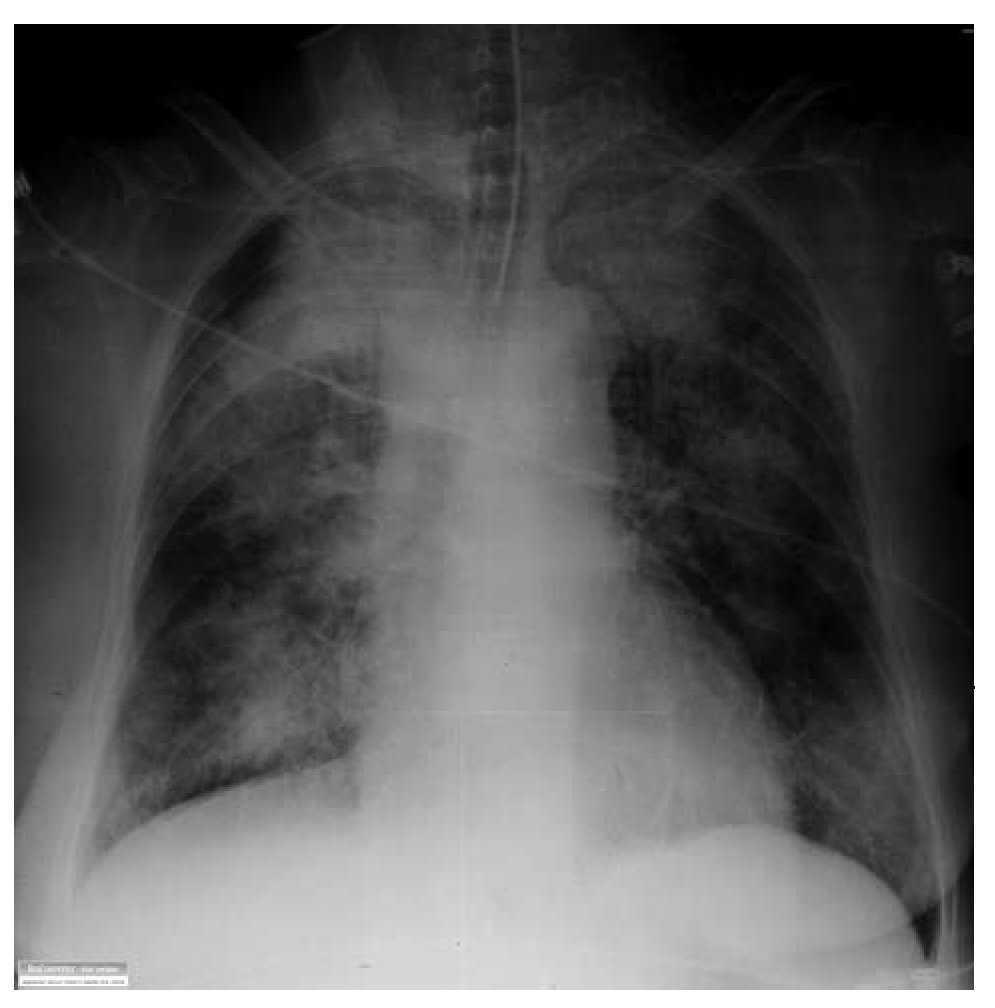 Alveolar Hemorrhage Following Tirofiban Treatment. A Misleading Diagnosis Revista Española de