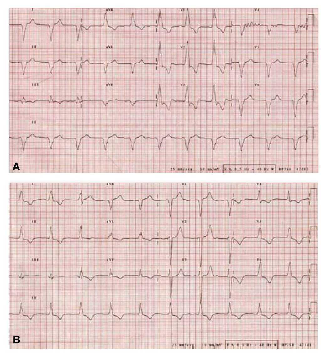 Echo image of right ventricular apex (RVA) pacemaker, pressure