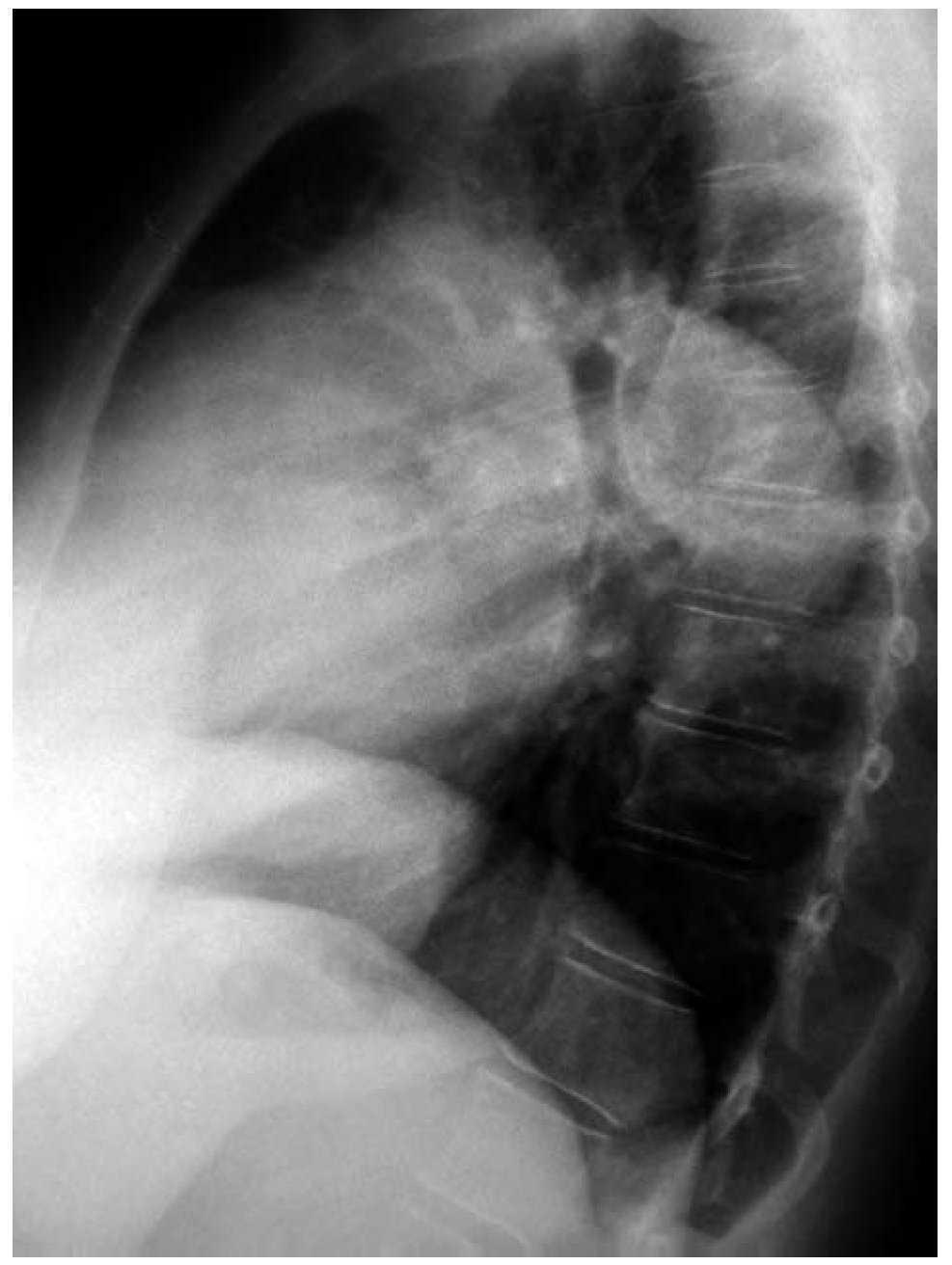 Complications of Proximal Pulmonary Artery Aneurysm in Patients With ...