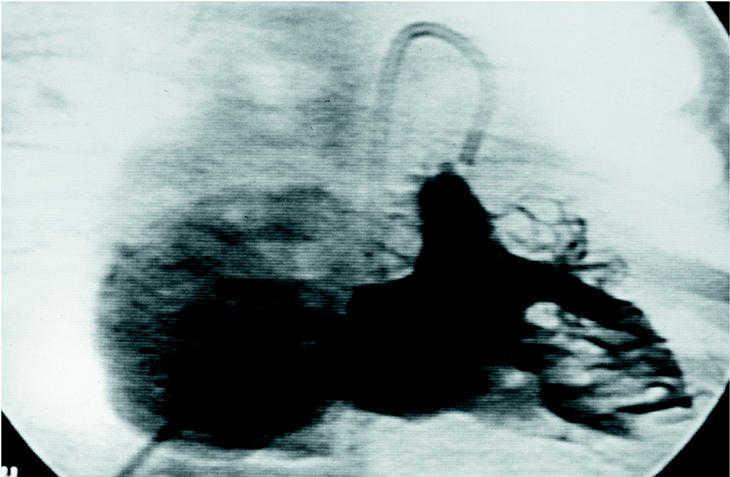 Ductus Venoso Flujo Anterogrado Ducto Venoso Reverso Corregido Dolor Lumbar Con Dolor En El Muslo Delantero