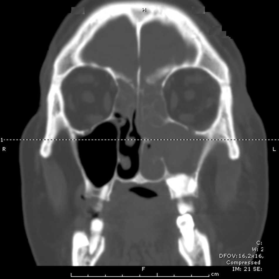 Sarcoma de Ewing: una rareza en la región nasosinusal | Acta