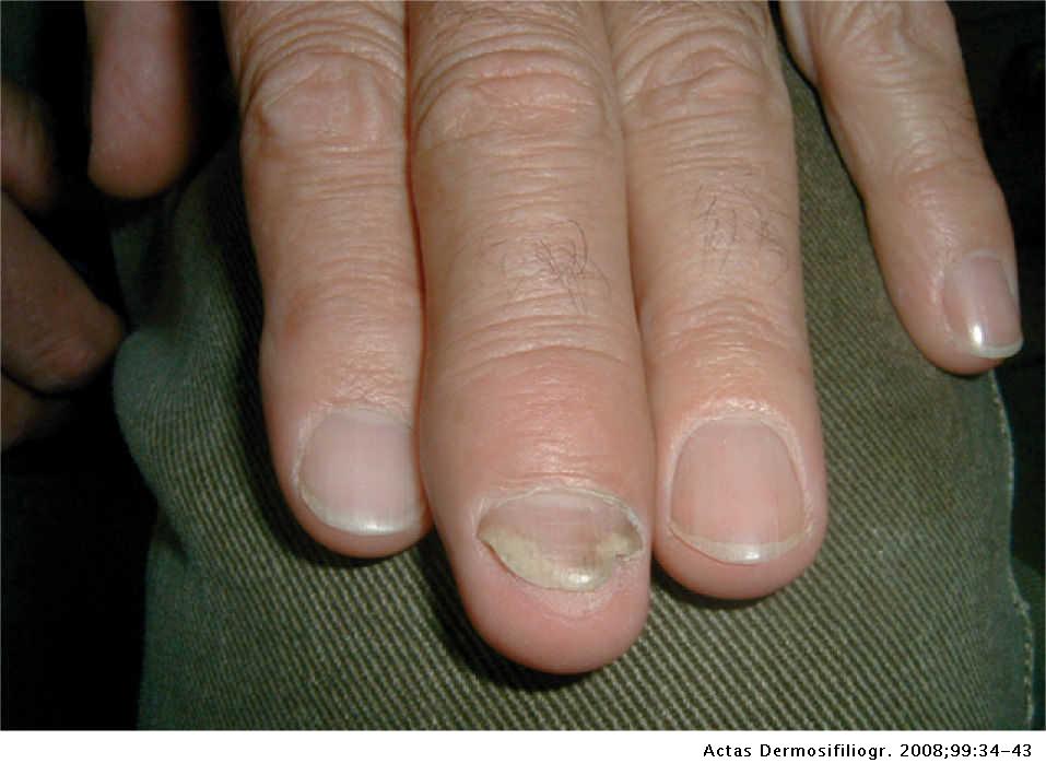 psoriasis ungueal características