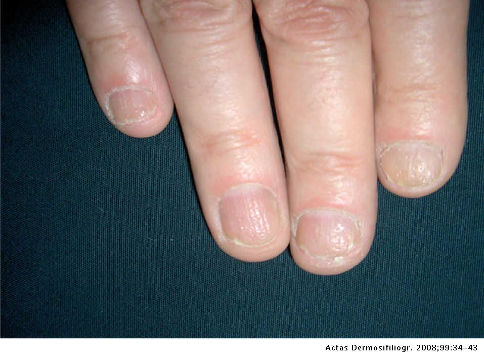 psoriasis ungueal características
